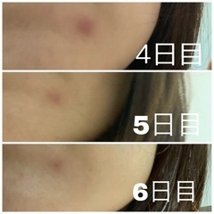 ニキビ、ニキビ跡、シミでお困りの方！ - 名古屋市