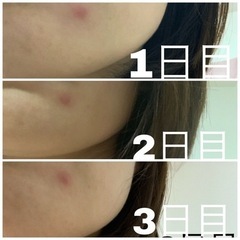ニキビ、ニキビ跡、シミでお困りの方！