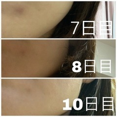 ニキビ、ニキビ跡、シミでお困りの方！ - 手伝って/助けて