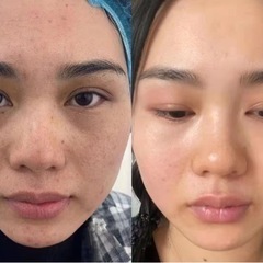 😍シミ、ソバカス、老斑取り相談応じます❣️ - 美容