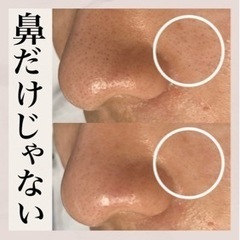 沖縄　毛穴エクストラクションで毛穴美人