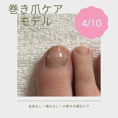 巻き爪補正ケア　経過観察モデル募集