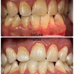 セルフホワイトニング体験してみませんか？