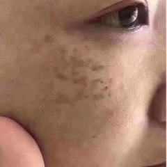 🤩無料シミ取り体験、すっぴん美人なりたい彼女必見🥰 - 美容
