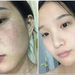 🤩無料シミ取り体験、すっぴん美人なりたい彼女必見🥰 - 那覇市