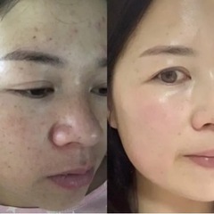 🤩無料シミ取り体験、すっぴん美人なりたい彼女必見🥰