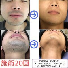 横浜エリアで最安値のメンズ脱毛専門　　完全都度払い　ヒゲ脱毛全体で１回３５００円 - 美容