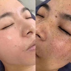 😍シミ、ソバカス、老斑取り相談応じます❣️ − 沖縄県