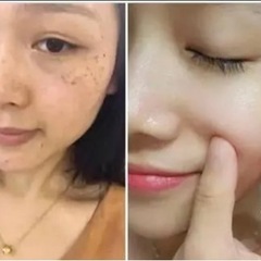 ❤️‍🔥 シミ取り、除去体験実施中カウンセリング雀斑(そば…