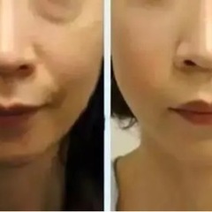モデルや芸能人も受けている速攻小顔、結果重視で照射致します！二重顎の解消自信あり - 美容