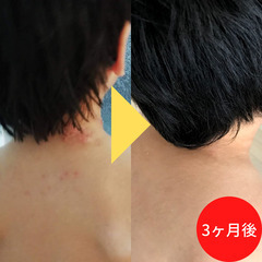 アトピー性皮膚炎を改善させるセラピスト養成講座の画像