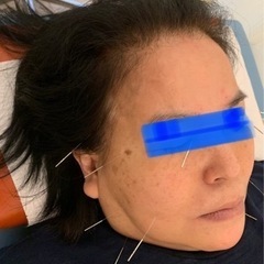 アンチエイジング、リフトアップに有効な美容鍼のご案内です‼️