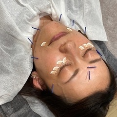 ヒアルロン酸ヒト幹細胞培養液と美顔鍼で若々しく − 埼玉県