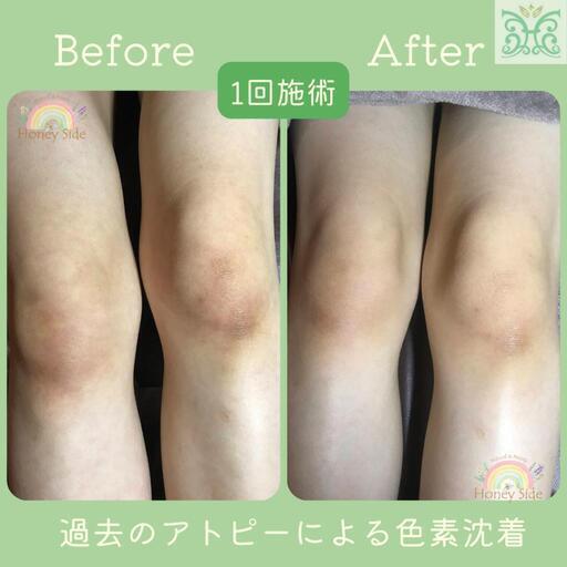 口コミ＆エリア1位☆メンズもOK☆剥離するハーブ☆22時半まで