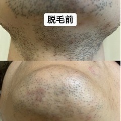 自宅脱毛サロン⭐️スターダイヤ　【リニューアルオープン記念】