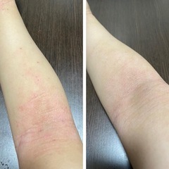 アトピーで悩んでる方！！！話してみませんか？？ - 向日市