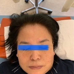リフトアップ、肌の若返りに効果的な美容鍼のご案内です‼️