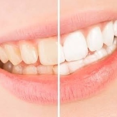 歯のセルフホワイトニング✨