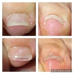 巻き爪でお悩みの方 - 美容
