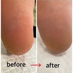 フットケア 角質ケア 魚の目 タコ 爪切り 爪のケア