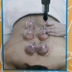 ☆早い者勝ち☆カッピング 吸い玉 24個セット（超美品）☆肩こり...