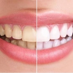 脱毛・ホワイトニング始めませんか??
