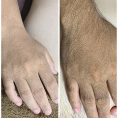 キャンペーン5.7パーツ脱毛（VIO.お顔含む）（都度払い）男女対応脱毛初心者歓迎 - 浦添市