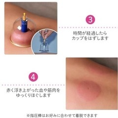 🇨🇦吸玉、カーピンク、肩凝りなどにの画像