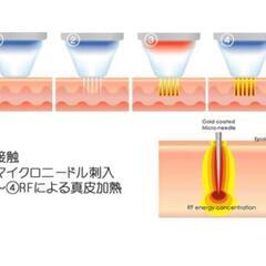 マイクロニードルRF (ポテンツァ)の画像