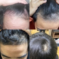 薄毛改善カウンセリング頭皮チェック