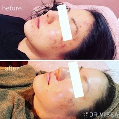 【お得なキャンペーン中】クイックセルフ脱毛＆光フォトフェイシャル - 地元のお店