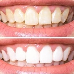 🦷✨ホワイトニングのモニターさま募集✨🦷