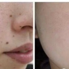 🥰お顔のほくろ悩んでる方、ご相談応じます🥰