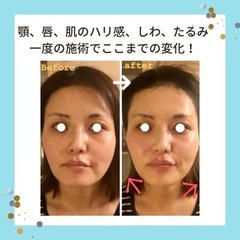 ☆バービーの肌を変えた話題のダーマペン【モニター様３名募集】 - 那覇市