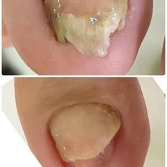 トラブルフットケアマスターセミナーの画像