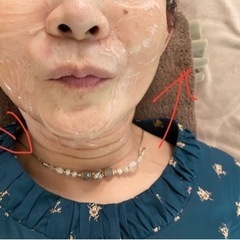60代の方3Dウルトラwリフト施術10分後⋯⋯