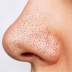 いちご鼻のケア、考え方教えます