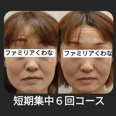 【あと1名】顔が変わる美容鍼 − 三重県