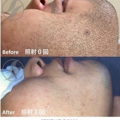 お顔脱毛•髭脱毛　光フェイシャル✨全身脱毛