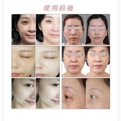 ハイフ HIFU 郵送可 美顔器 家庭用 の画像