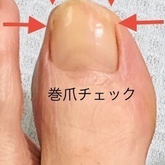 足爪押すと痛い⁉️巻爪を疑って下さい‼️【再投稿】