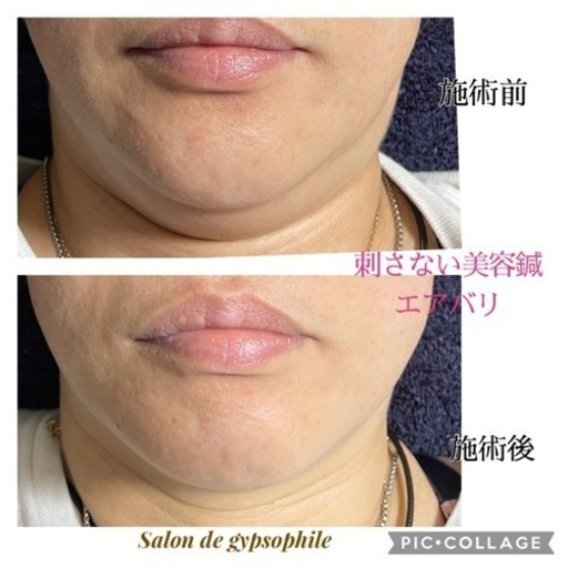 鍼を刺さない美容鍼☆エアバリ (カスミン) 一ノ割のエステの無料 鍼を刺さない美容鍼☆エアバリ (カスミン) 一ノ割のエステの無料