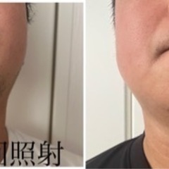 光脱毛　顔脱毛・ヒゲ脱毛　もちもち ツルツル美肌