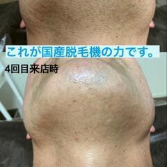 【残5名】メンズ☆ヒゲ脱毛モニター募集 - 中頭郡