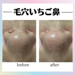 感動レベル👃黒ずみ撃退👃