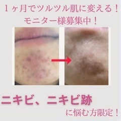 ニキビ悩みのある方ご協力ください🙇‍♂️