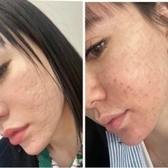 お肌の凸凹悩んでる方必見🥰妊娠線にも改善されます😍 - 那覇市