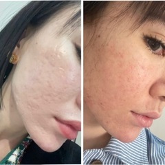お肌の凸凹悩んでる方必見🥰妊娠線にも改善されます😍