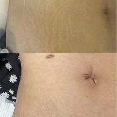 お肌の凸凹悩んでる方必見🥰妊娠線にも改善されます😍 - 地元のお店