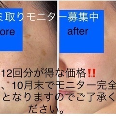 シミ取りモニター募集‼️